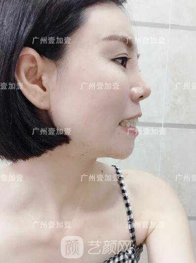 真實齙牙矯正牙齒案例