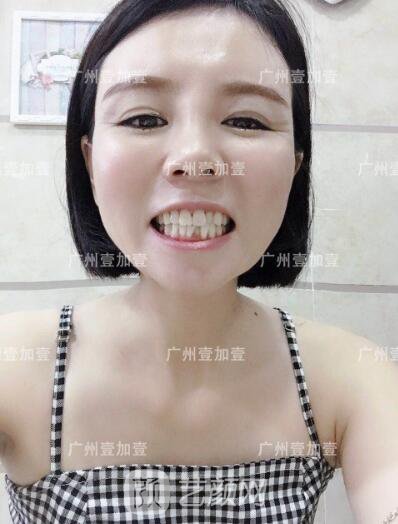 真實齙牙矯正牙齒案例