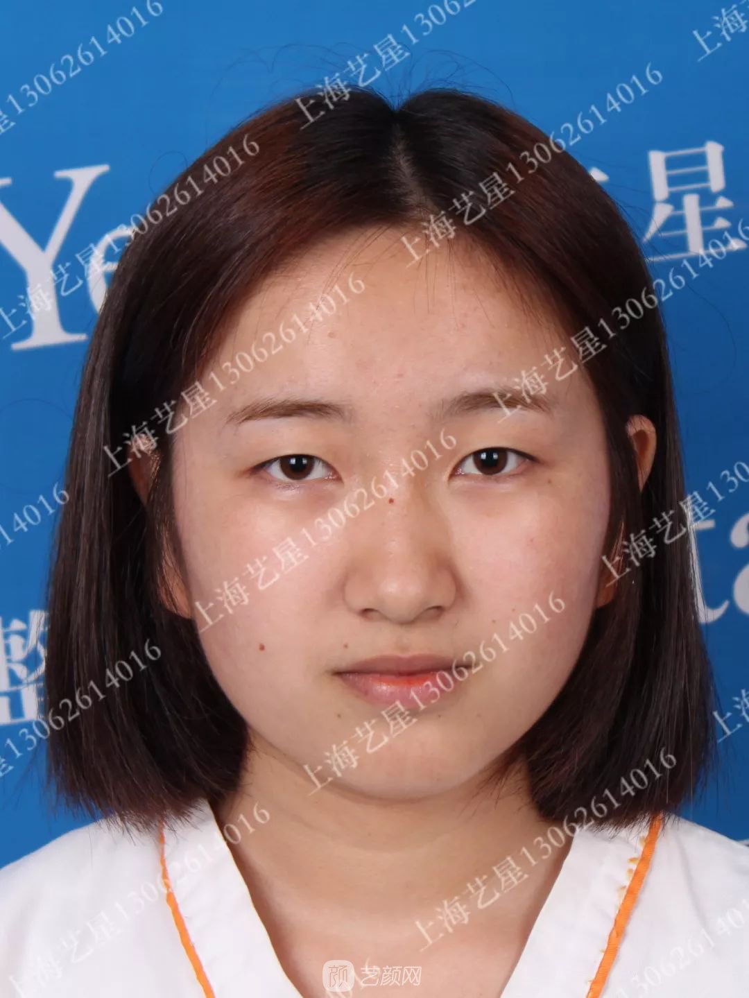 上海藝星割雙眼皮術(shù)后一個(gè)月恢復(fù)日記一則~