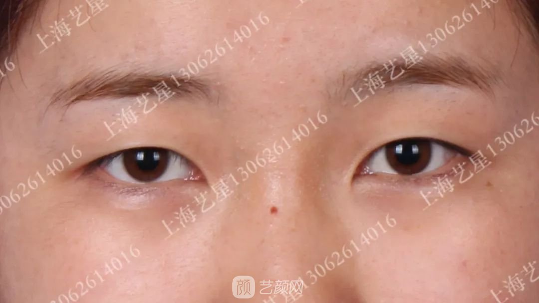 上海藝星割雙眼皮術(shù)后一個(gè)月恢復(fù)日記一則~