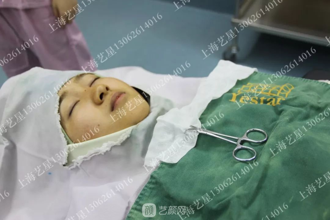 上海藝星割雙眼皮術(shù)后一個(gè)月恢復(fù)日記一則~