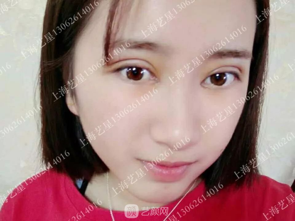 上海藝星割雙眼皮術(shù)后一個(gè)月恢復(fù)日記一則~
