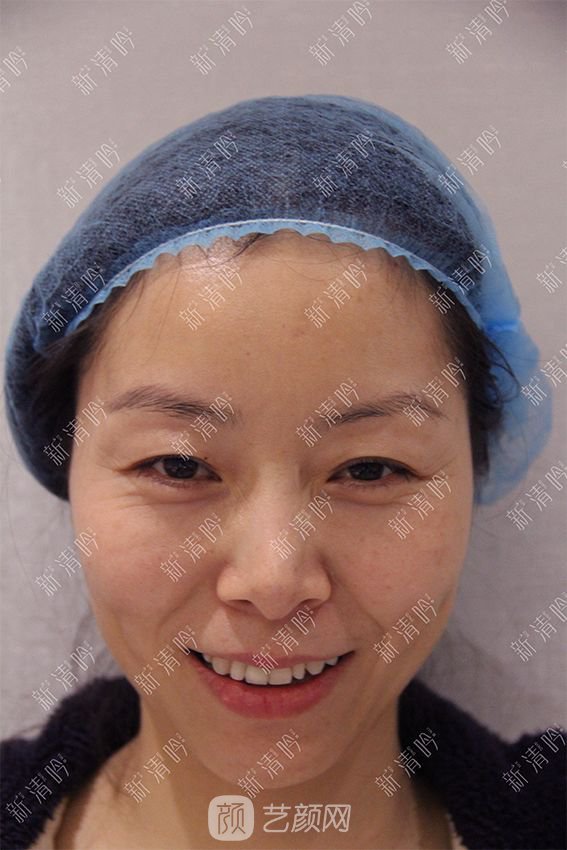 杭州新清吟陳永自體脂肪面部填充+注射瘦臉除皺案例直播~