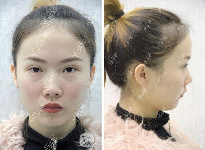 耳軟骨隆鼻果圖分享，術(shù)后~