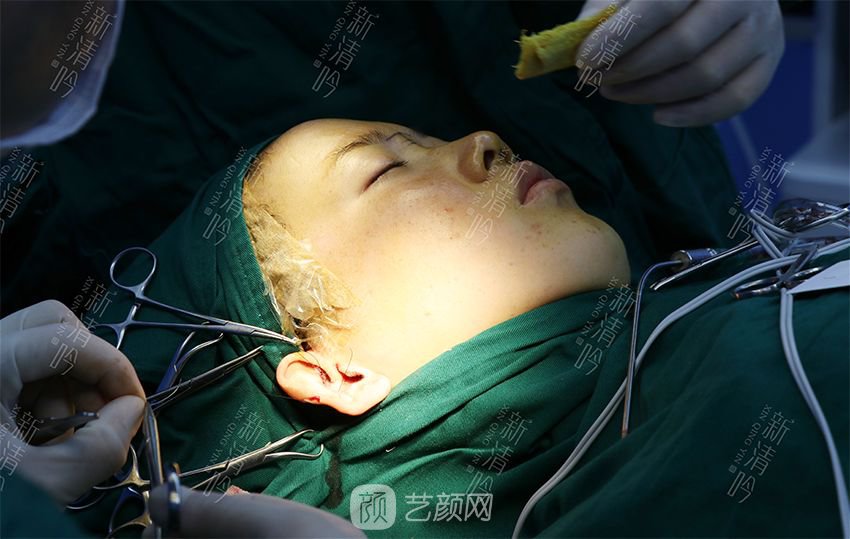 耳軟骨隆鼻果圖分享，術(shù)后~