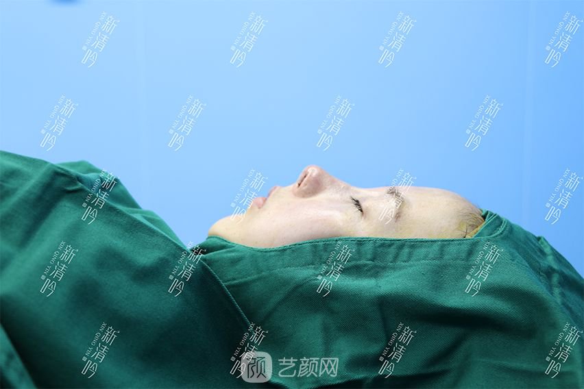 耳軟骨隆鼻果圖分享，術(shù)后~