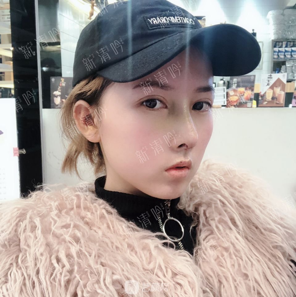 耳軟骨綜合隆鼻半個月了，分享恢復(fù)果照片~