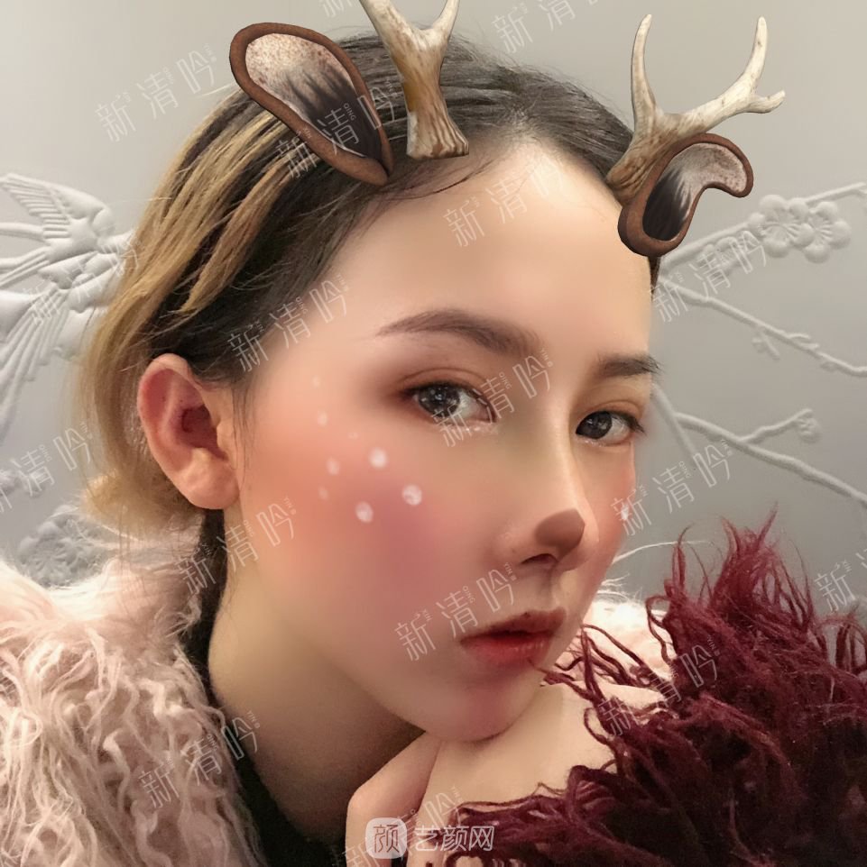 耳軟骨綜合隆鼻半個月了，分享恢復(fù)果照片~