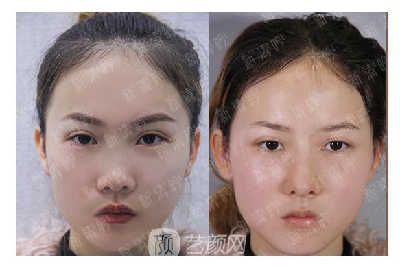 耳軟骨綜合隆鼻半個月了，分享恢復(fù)果照片~