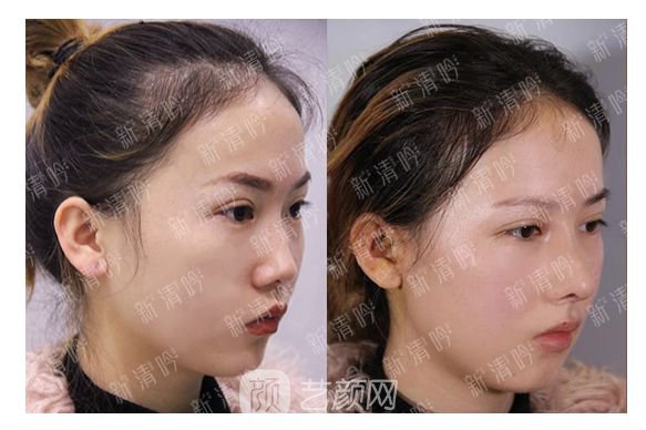 耳軟骨綜合隆鼻半個月了，分享恢復(fù)果照片~