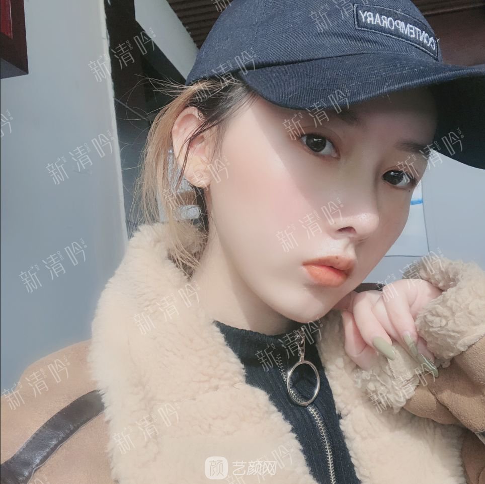 耳軟骨綜合隆鼻半個月了，分享恢復(fù)果照片~