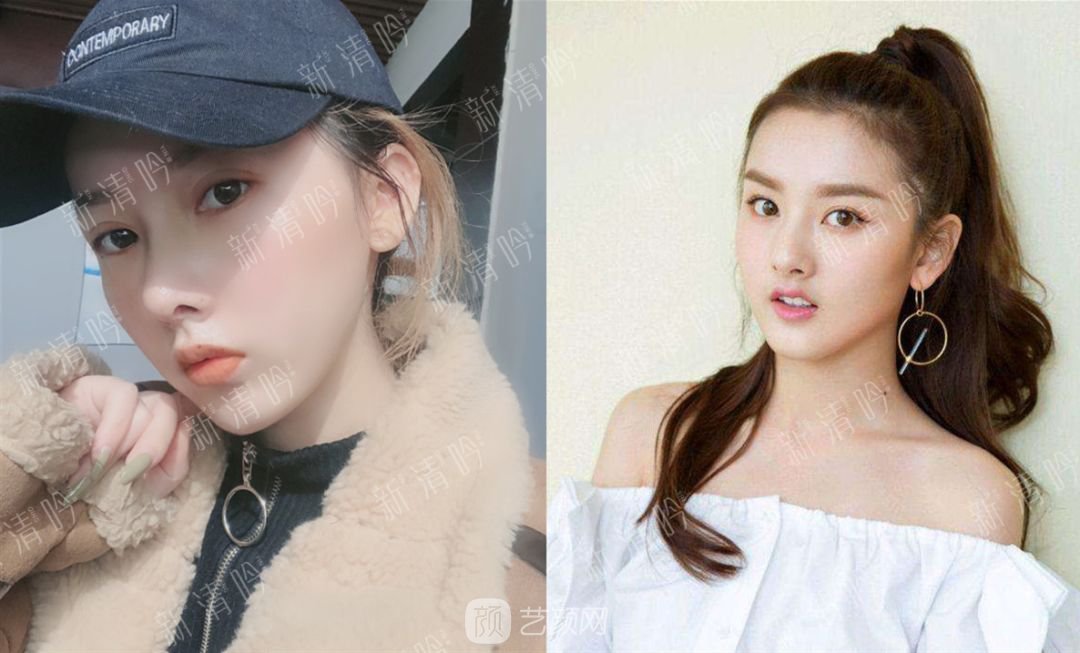 耳軟骨綜合隆鼻半個月了，分享恢復(fù)果照片~