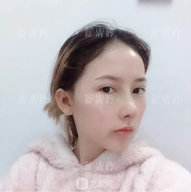 耳軟骨隆鼻果怎么樣？案例照片一覽~