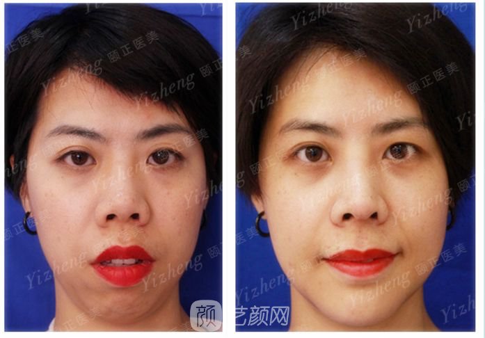 自體肋軟骨隆鼻+假體隆下頜一個月果照片分享~