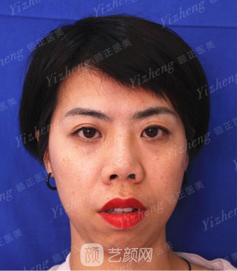 自體肋軟骨隆鼻+假體隆下頜一個月果照片分享~