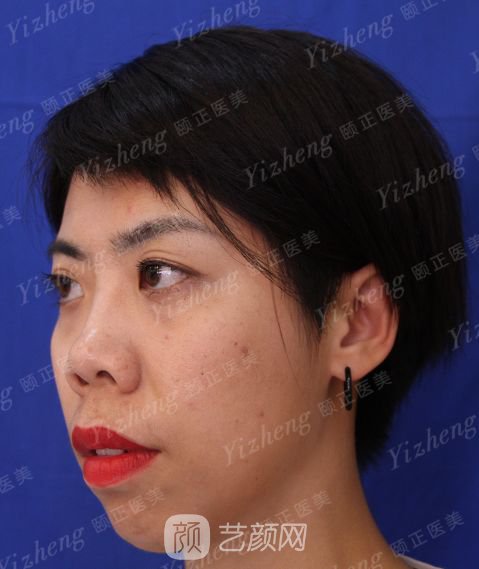 自體肋軟骨隆鼻+假體隆下頜一個月果照片分享~