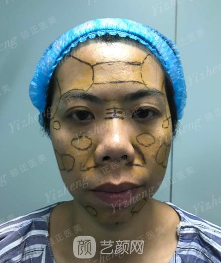 自體肋軟骨隆鼻+假體隆下頜一個月果照片分享~