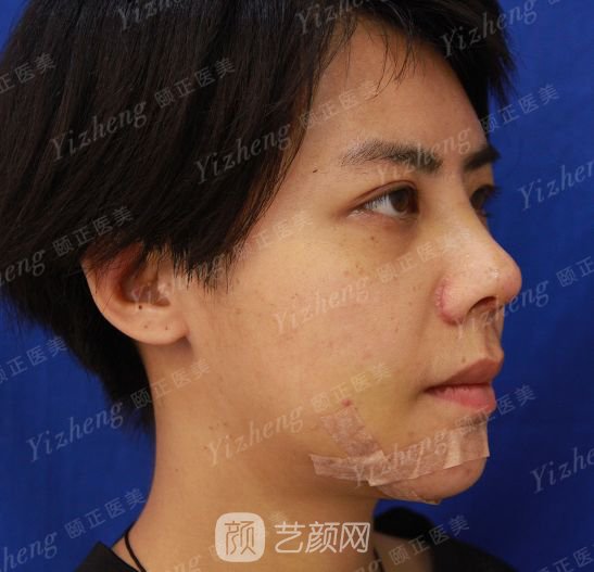 自體肋軟骨隆鼻+假體隆下頜一個月果照片分享~