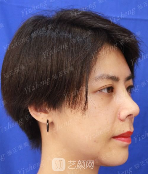 自體肋軟骨隆鼻+假體隆下頜一個月果照片分享~