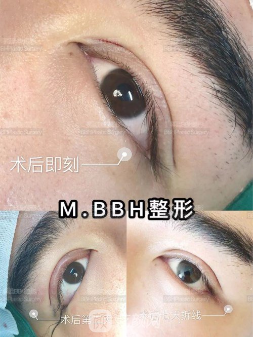 眼部手術(shù)案例——昆明募藍(lán)術(shù)后一年果照片分享~