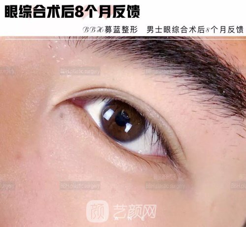 眼部手術(shù)案例——昆明募藍(lán)術(shù)后一年果照片分享~