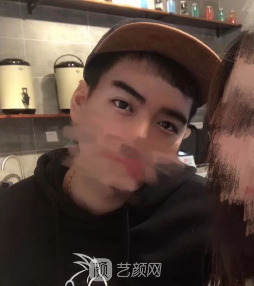 眼部手術(shù)案例——昆明募藍(lán)術(shù)后一年果照片分享~