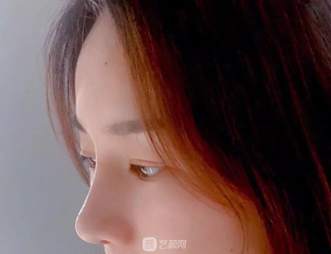 鼻部手術(shù)一個月恢復(fù)日記分享~