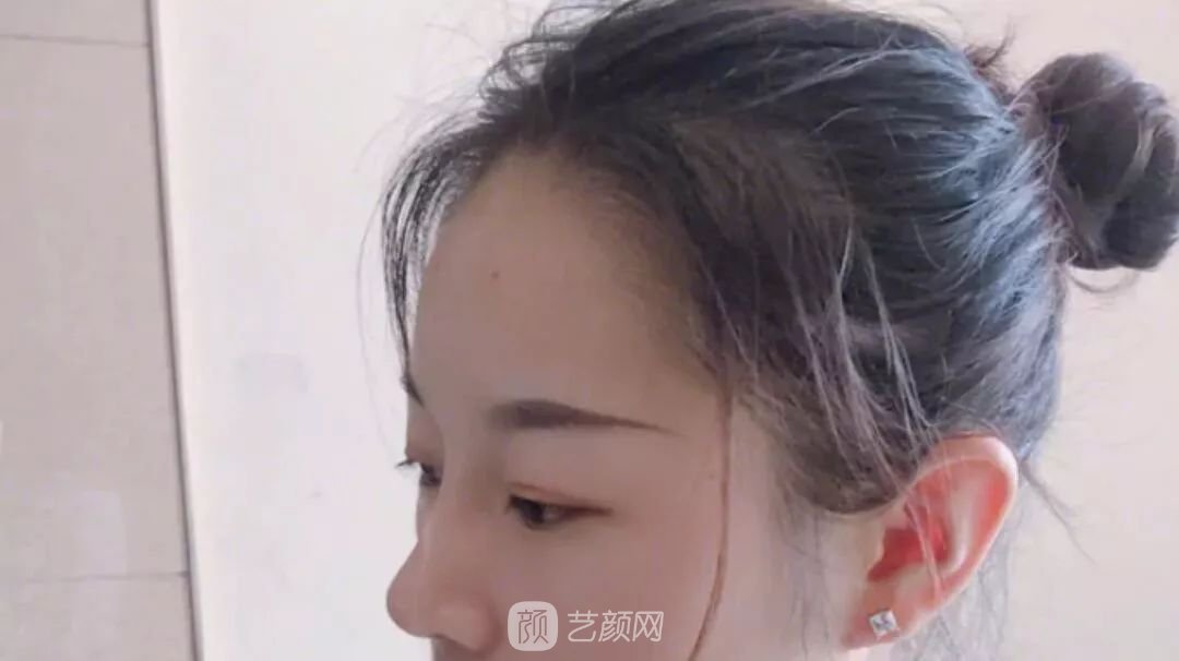 鼻部手術(shù)一個月恢復(fù)日記分享~