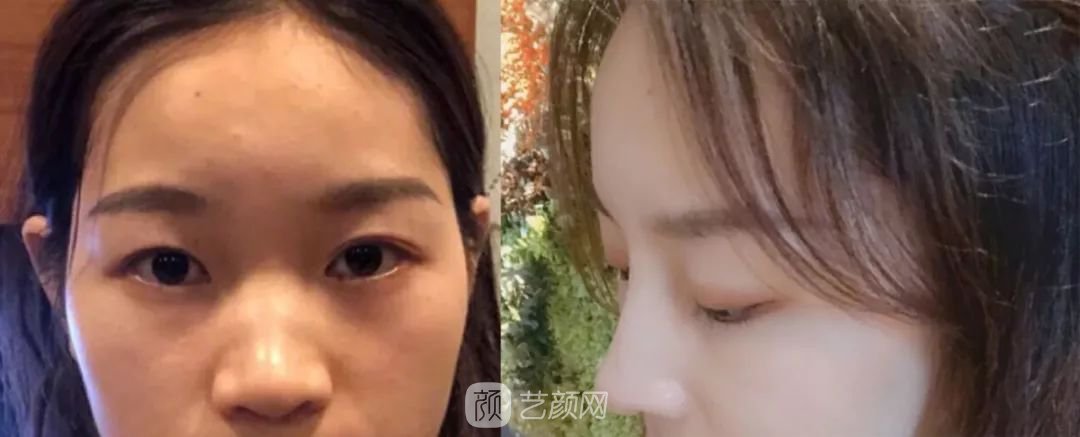 鼻部手術(shù)一個月恢復(fù)日記分享~