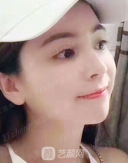 葫蘆島頤正夏秉成鼻部手術(shù)+SVF自體脂肪多方面部填充案例~