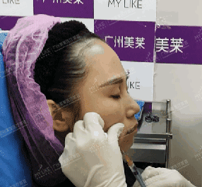 廣州美萊玻尿酸全臉填充果照片分享~