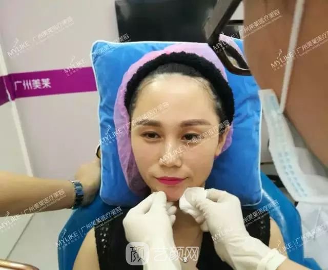 廣州美萊玻尿酸全臉填充果照片分享~