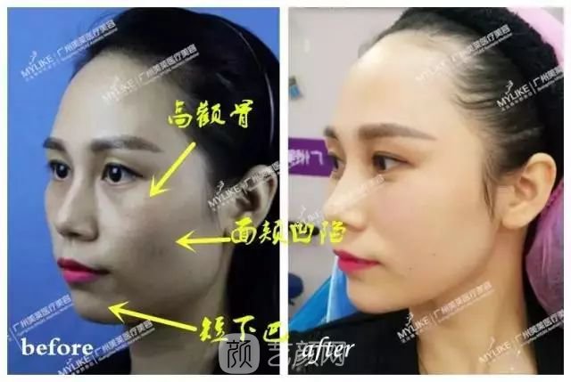 廣州美萊玻尿酸全臉填充果照片分享~