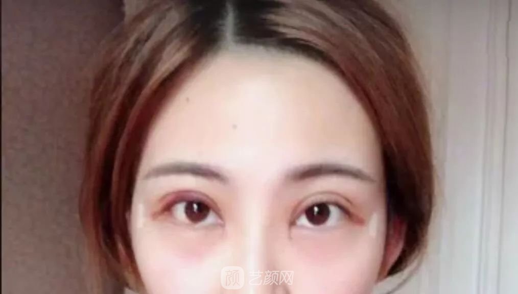 眼部手術(shù)一個(gè)月恢復(fù)日記，片分享~