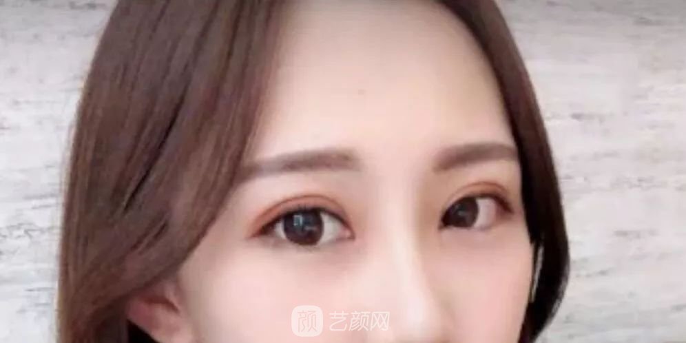 眼部手術(shù)一個(gè)月恢復(fù)日記，片分享~