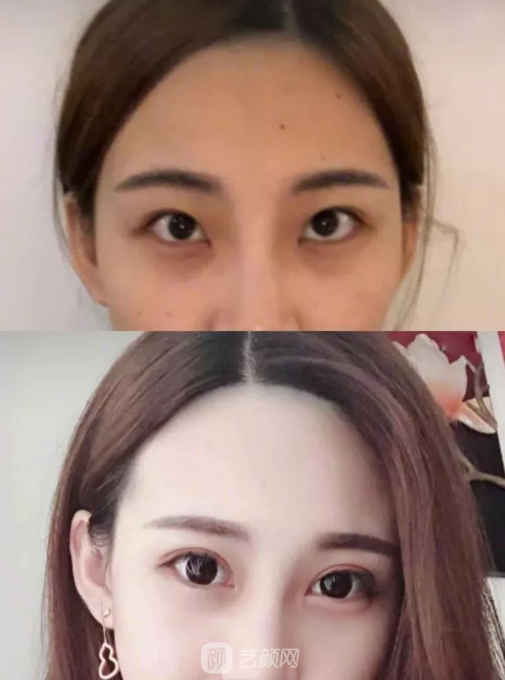 眼部手術(shù)一個(gè)月恢復(fù)日記，片分享~