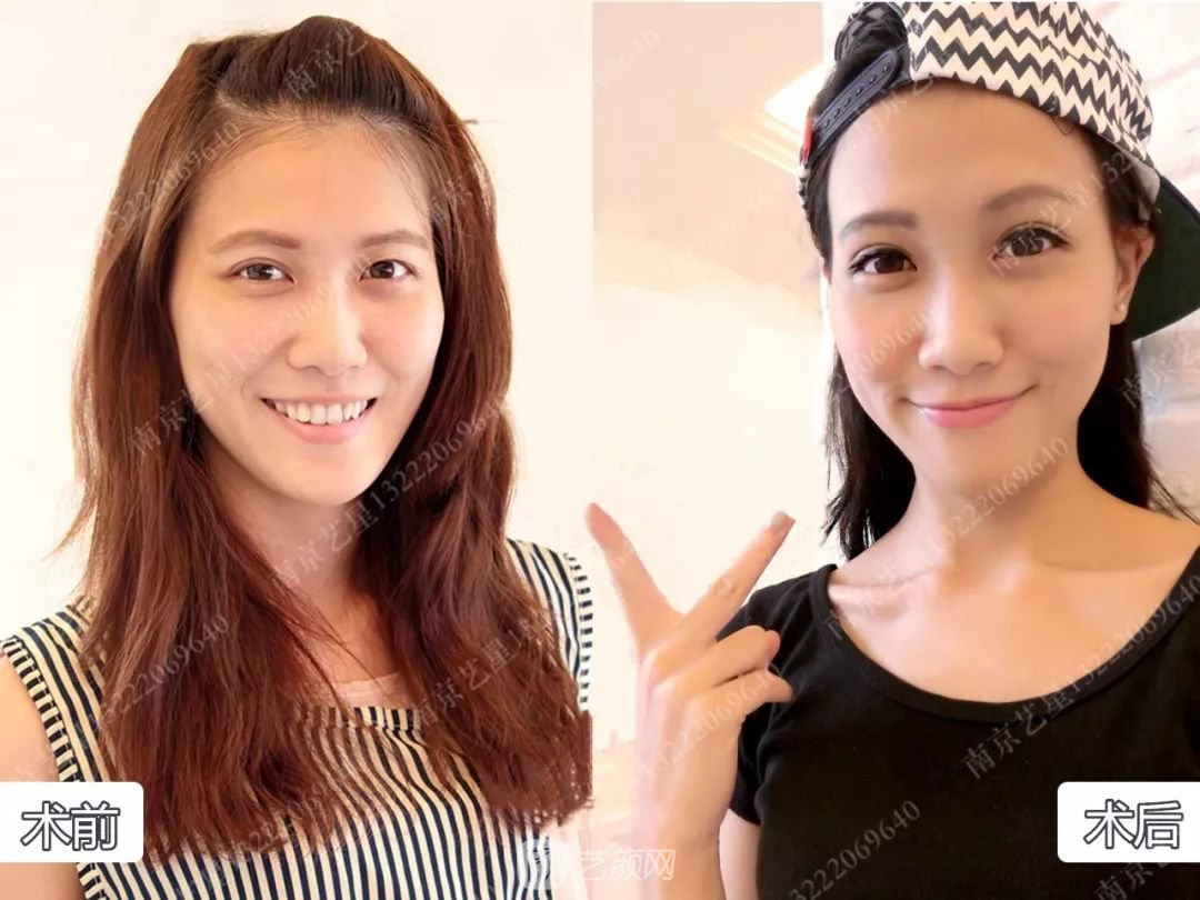 Yestar美杜莎美眼術(shù)一周案例圖片，芭比雙眼皮果很好~