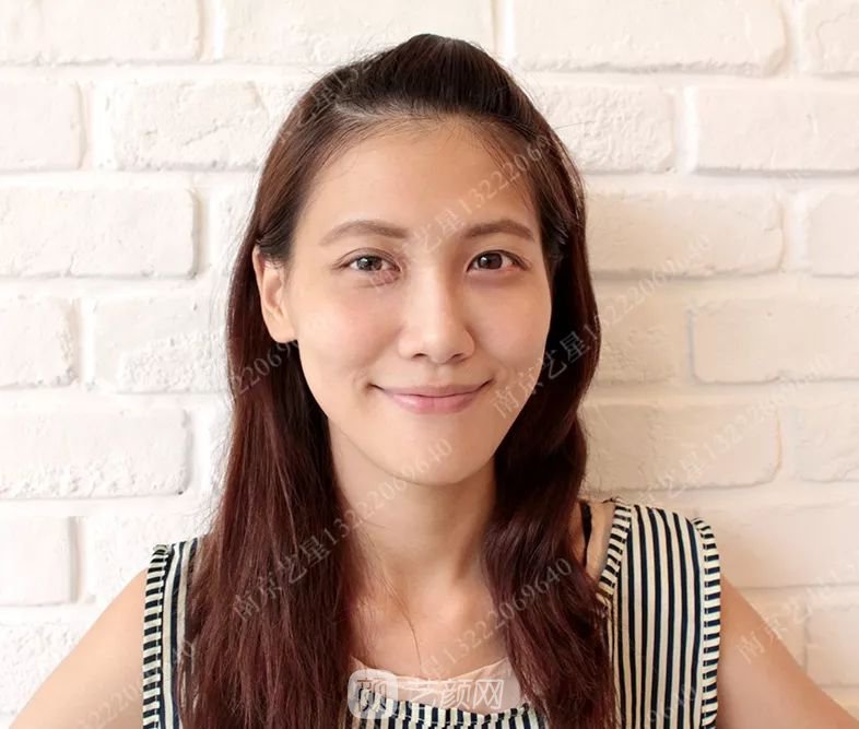 Yestar美杜莎美眼術(shù)一周案例圖片，芭比雙眼皮果很好~