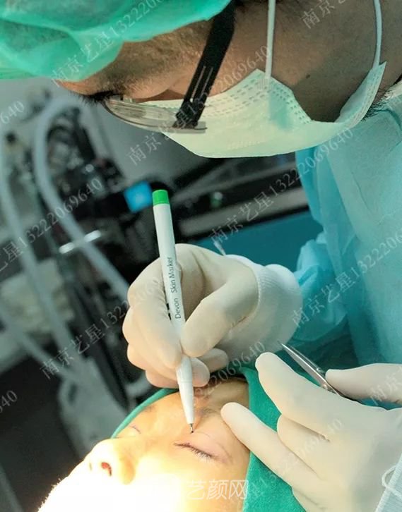 Yestar美杜莎美眼術(shù)一周案例圖片，芭比雙眼皮果很好~