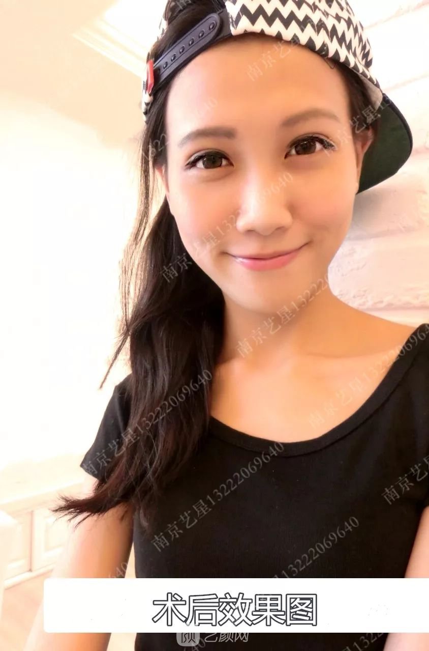 Yestar美杜莎美眼術(shù)一周案例圖片，芭比雙眼皮果很好~