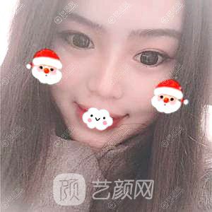 四川隆鼻哪家醫(yī)院好？成都成美馮春雨硅膠隆鼻+假體墊下巴恢復(fù)果圖