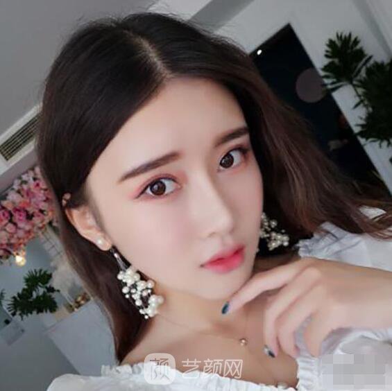 顴骨內(nèi)推真實(shí)案例，小臉網(wǎng)紅模板臉型