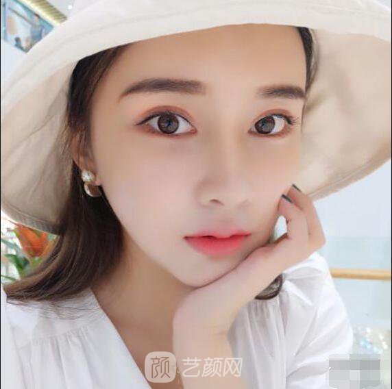 顴骨內(nèi)推真實(shí)案例，小臉網(wǎng)紅模板臉型