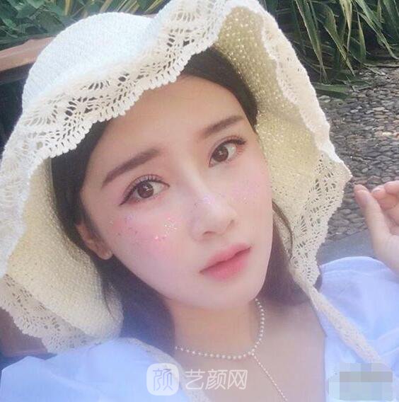 顴骨內(nèi)推真實(shí)案例，小臉網(wǎng)紅模板臉型