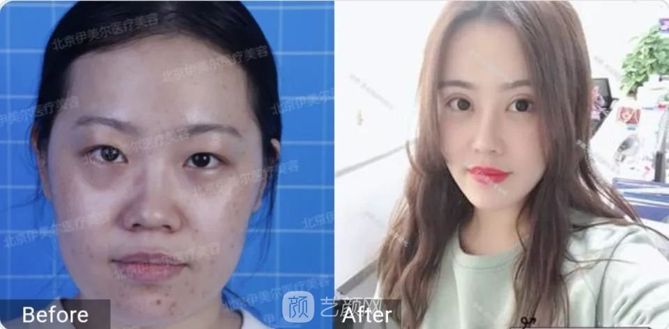 伊美爾幸福李輝靈動面部年輕化術(shù)后兩個月恢復日記~