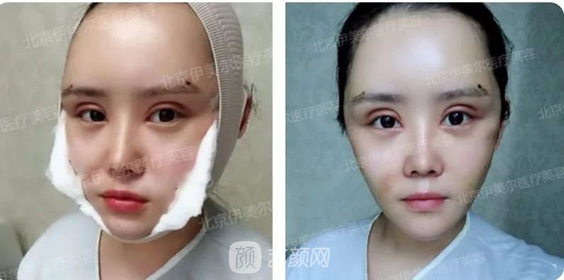 伊美爾幸福李輝靈動面部年輕化術(shù)后兩個月恢復日記~