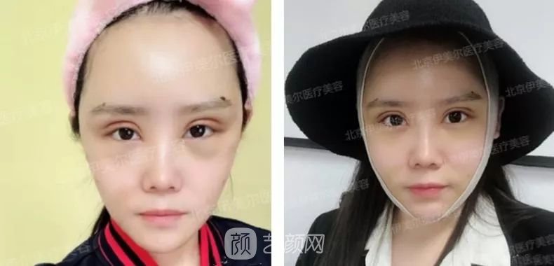 伊美爾幸福李輝靈動面部年輕化術(shù)后兩個月恢復日記~