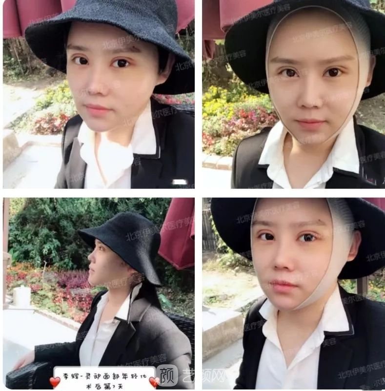 伊美爾幸福李輝靈動面部年輕化術(shù)后兩個月恢復日記~