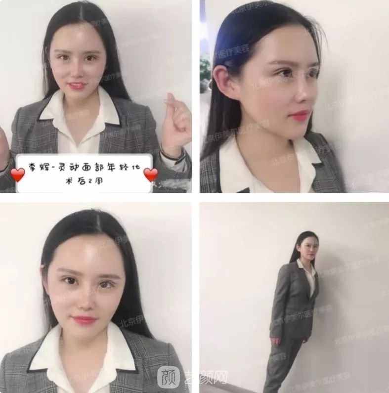 伊美爾幸福李輝靈動面部年輕化術(shù)后兩個月恢復日記~