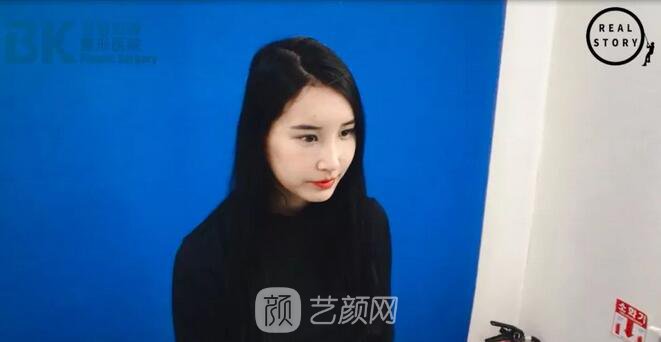 【新西蘭美女整形日記】鼻部手術(shù)+面部脂肪移植——BK整形醫(yī)院